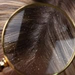 5 Cara Atasi Ketombe Membandel dengan Bahan Alami